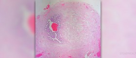 Complications of rubber band ligation