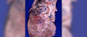 Complications of sarcoidosis