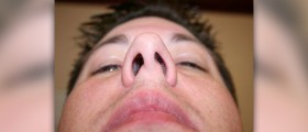 Complications of septoplasty