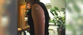 Complications of typhoid