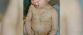 Complications of varicella