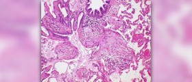 Complications of walking pneumonia