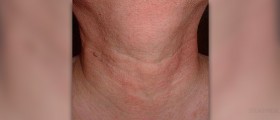 Constant sore throat