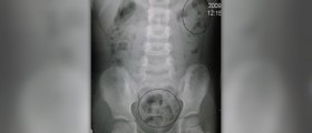 Constipation in infants treatment