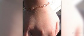 Copper bracelets and arthritis