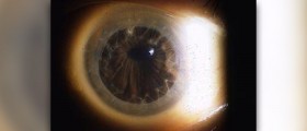 Cornea eye diseases