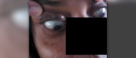 Corneal abrasion treatment