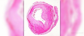 Coronary artery disease symptoms