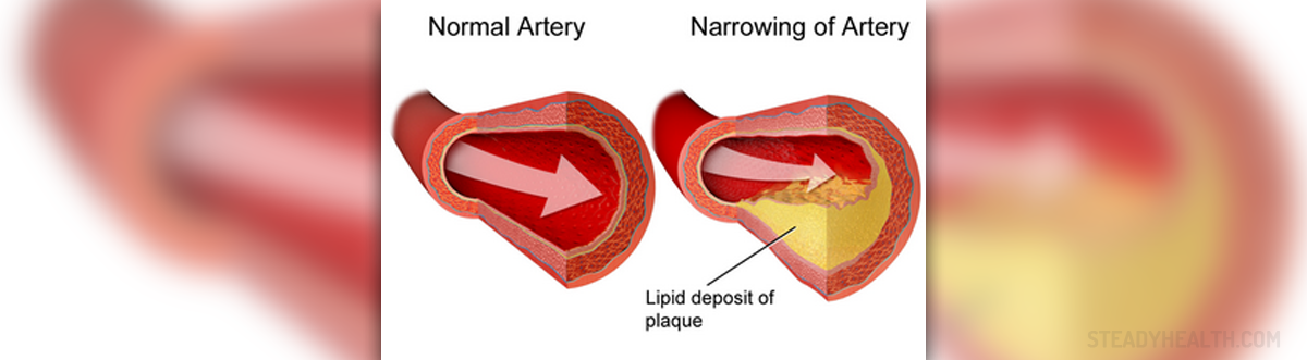 test-for-blocked-arteries-cardiovascular-disorders-and-diseases