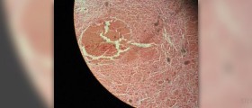 Corpus luteum cyst