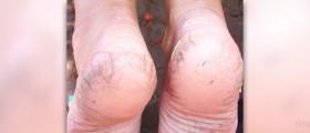 Cracked heels causes