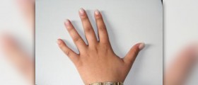 Cracked skin on fingers