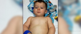Croup in babies