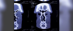 CT scan side effects