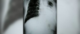 Cure for tuberculosis