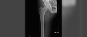 Curing bone cancer