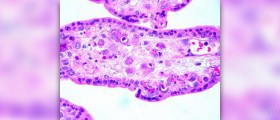Cytomegalovirus infects people around the globe