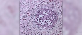 DCIS breast cancer