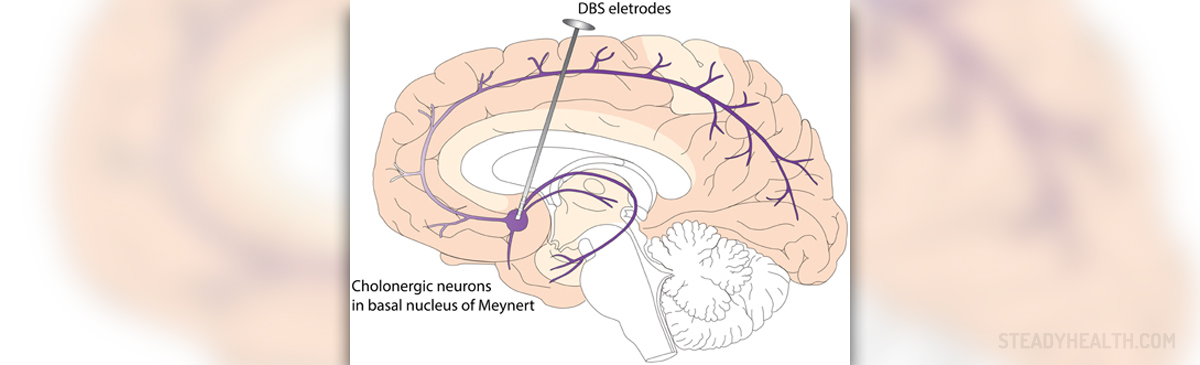 Complications of deep brain stimulation surgery | General ...