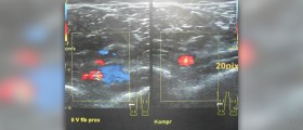 Deep vein thrombosis symptoms