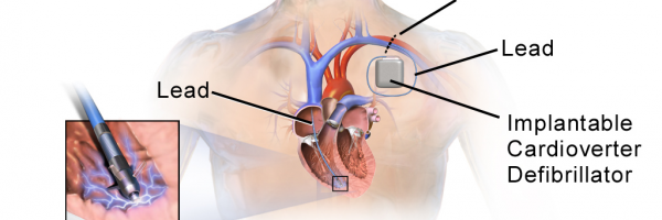 Defibrillator implant surgery
