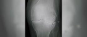 Degenerative arthritis - osteoarthritis symptoms
