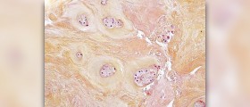 Degenerative disc disease