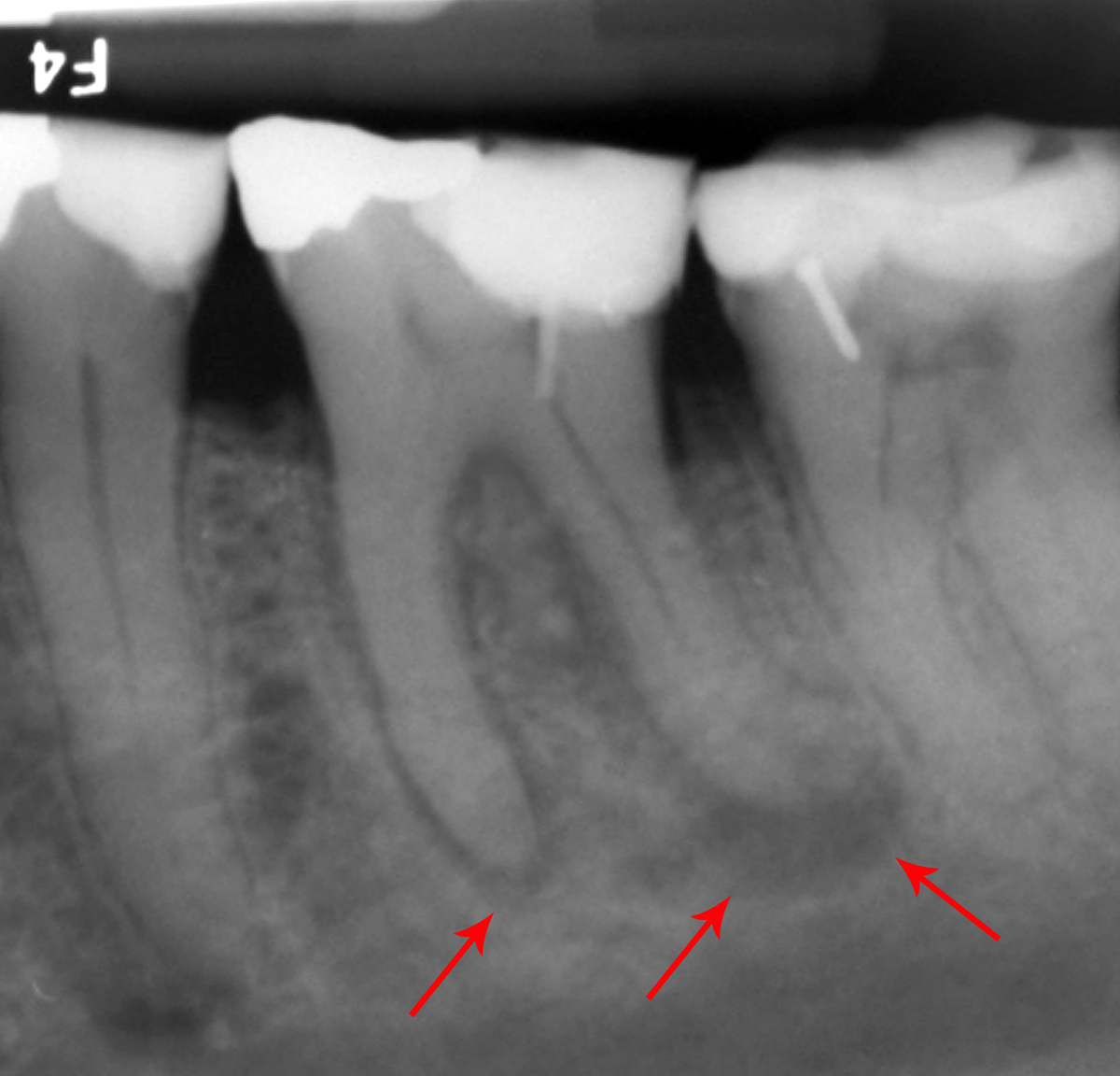 Dental abscess treatment | General center | SteadyHealth.com