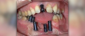 Dental implant failure causes