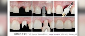 Dental implant surgery information