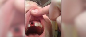Dental implants and bone graft