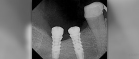 Dental implants diabetes