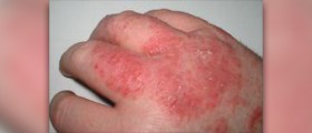 Dermatitis in baby