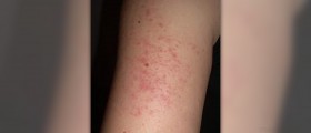 Dermatitis keratosis pilaris