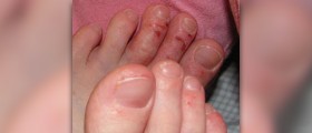 Dermatitis natural cure