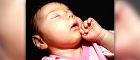 Dermatitis on baby face