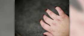 Dermatitis rash on skin