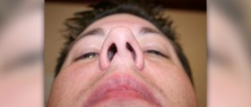 Deviated septum surgery recovery