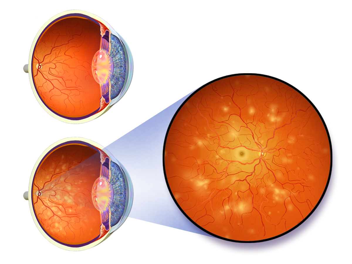 nonproliferative-diabetic-retinopathy-eye-disorders-and-diseases