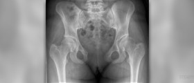Symphysis pubis dysfunction (SPD) during pregnancy