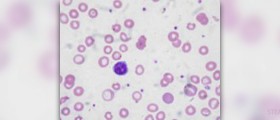 Dietary causes of anaemia