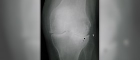 Dietary supplement for osteoarthritis