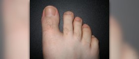 Discolored toenails facts