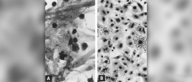Diseases caused by viruses