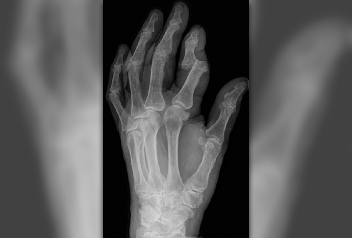 dislocated-finger-facts-musculoskeletal-issues-articles-body