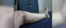 Dislocated kneecap treatment