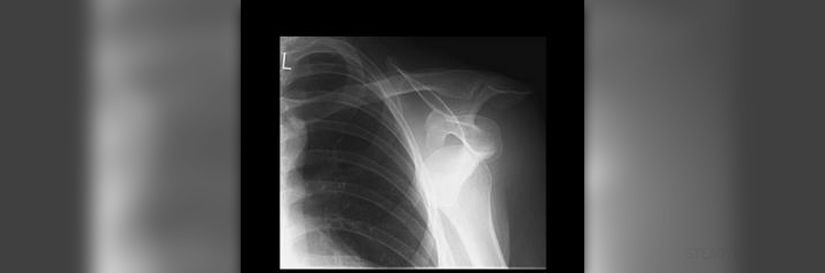 dislocated-shoulder-healing-time-general-center-steadyhealth