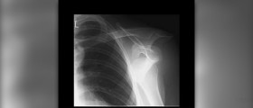 Dislocated shoulder surgery