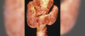 Disorder caused by hyperthyroidism
