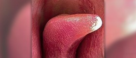 Disorder of the tongue